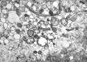 F,25y. | myopathy - atrophic and regenerating muscle cells